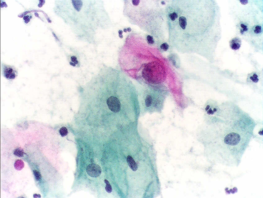 Pap test, Papanicolau stain, An obviously atypical cell can be seen.