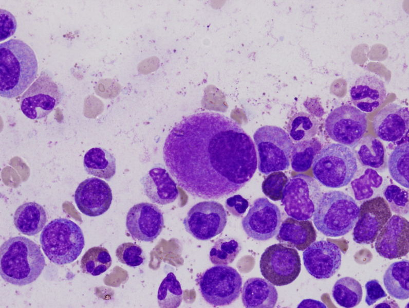 A small, hypolobated megakaryocyte in a bone marrow aspirate, typical of chronic myelogenous leukemia